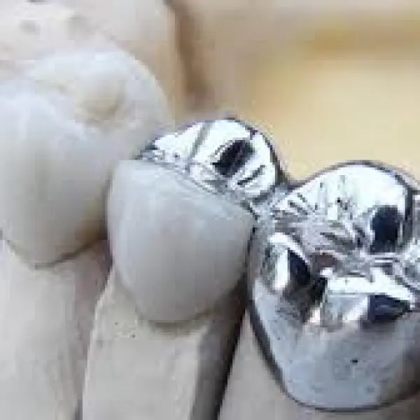 Bọc Răng Inox