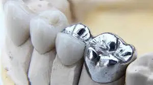 bọc răng inox 1