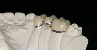 răng inox
